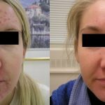 Acne Treatment Before and After