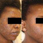 Acne Treatment Before and After Photo