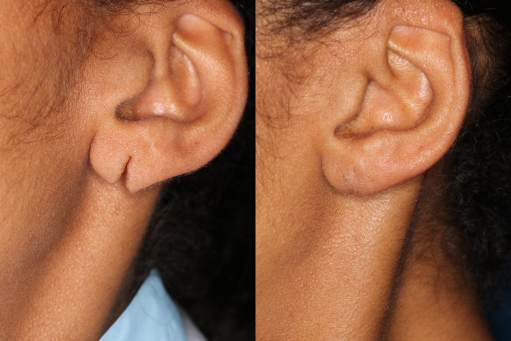 Earlobe Repair Washington DC Center For Laser Surgery