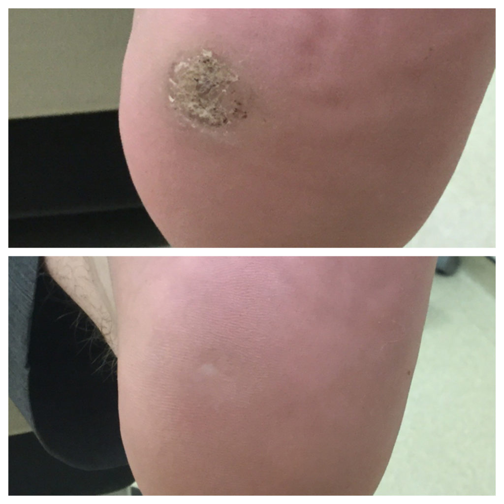hpv after wart removal