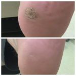 Wart Treatment Before and After