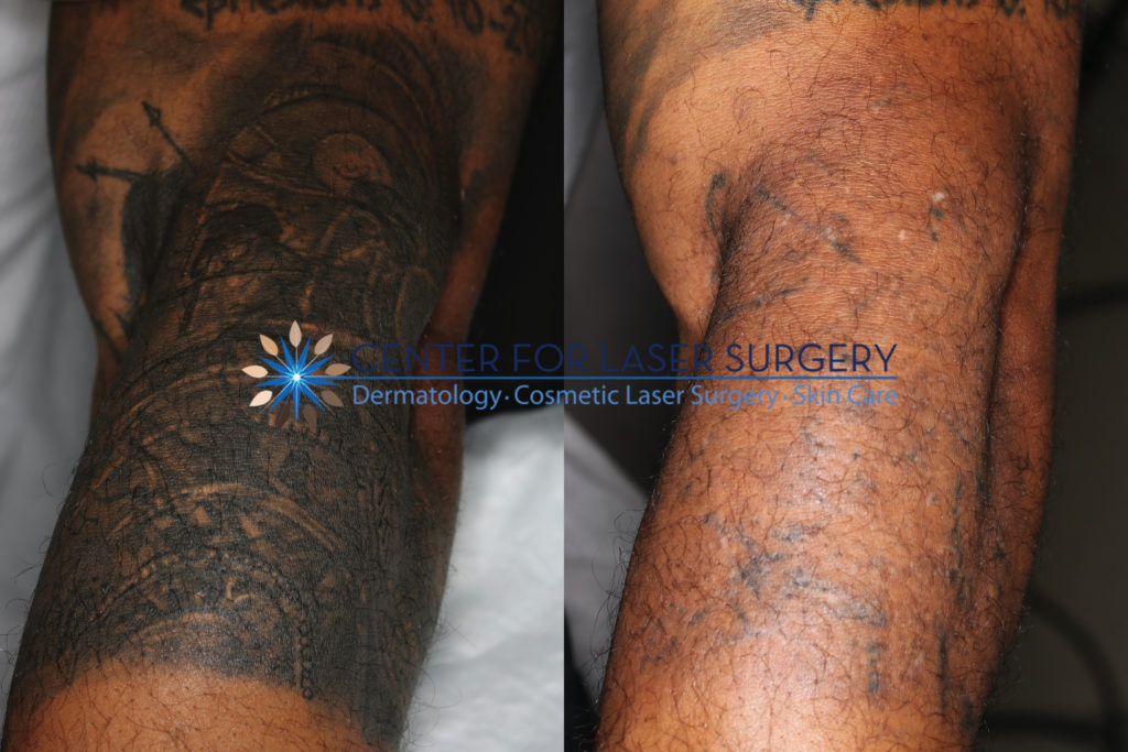 Tattoo Removal | Washington, DC | Center for Laser Surgery
