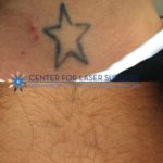 Washington DC Tattoo Removal