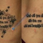 partial laser tattoo removal