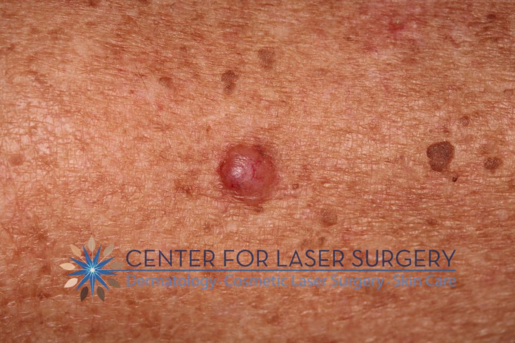 example of Basal Cell Carcinoma
