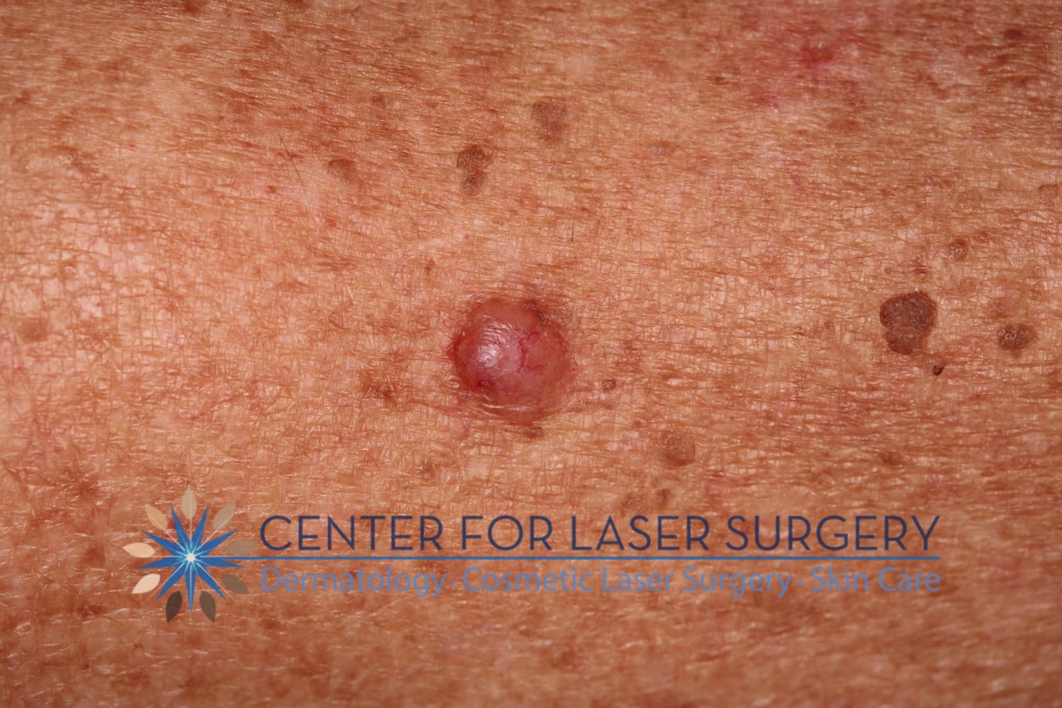 Skin Cancer Screening | Washington, DC | Dr. Thomas Adrian