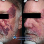 Facial Port Wine Stain Treatment