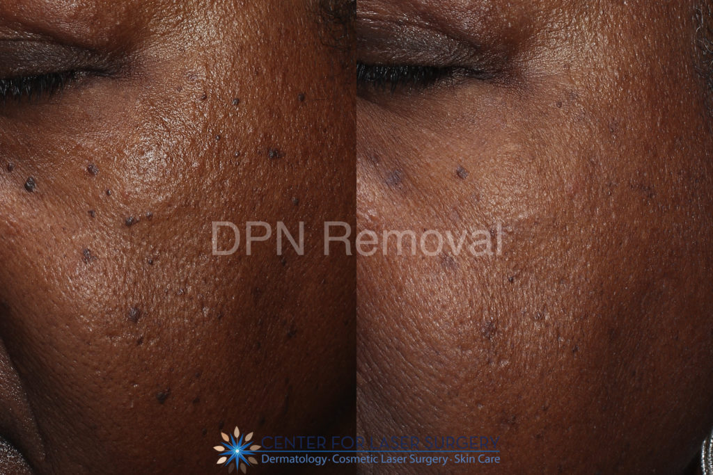 Dermatosis Papulosa Nigra Washington Dc Center For Laser Surgery