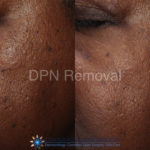 DPN Removal Before and After