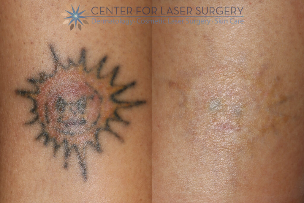 Removal | Washington, DC for Laser Surgery