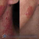 Face / Neck Port Wine Stain Laser Treatment