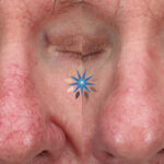 Laser Treatment of Nose Blood Vessels