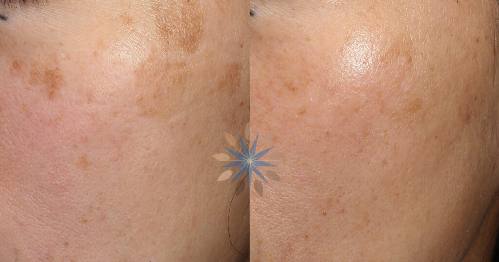 Laser Treatment of Sun Spots