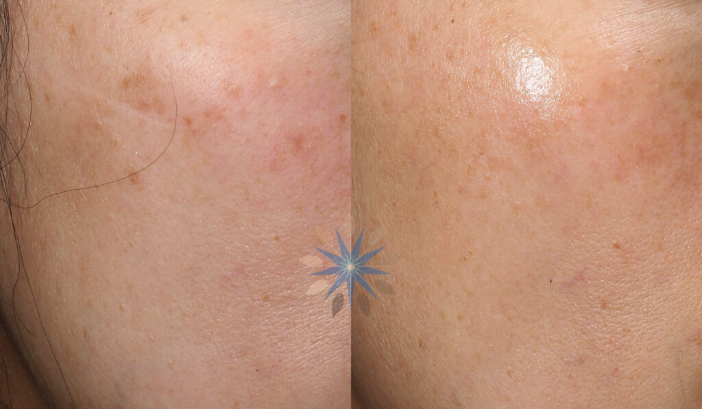 Laser Treatment of Lentigo / Age Spot