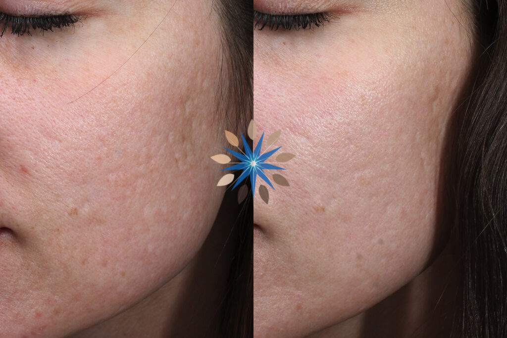 Acne Scar Treatment Before and After