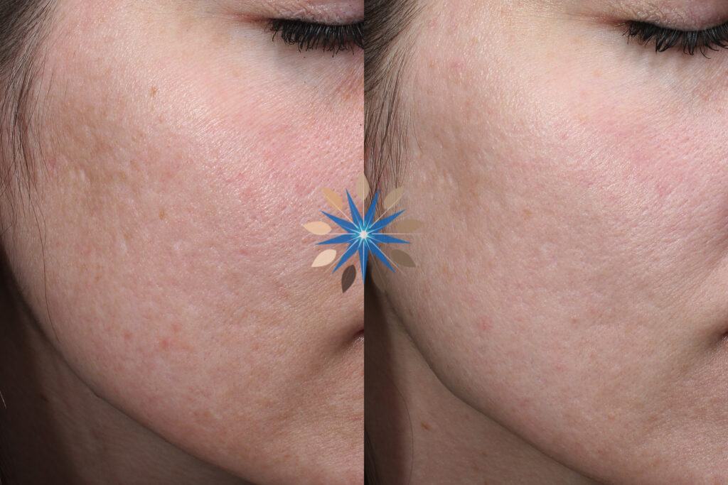 Acne Scar Treatment Before and After