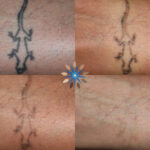 Laser Tattoo Removal Before and After