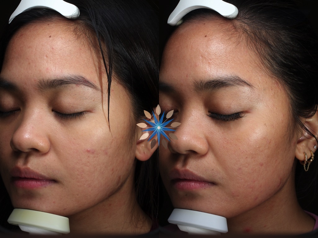 Before and After Photo of Acne Scar Removal