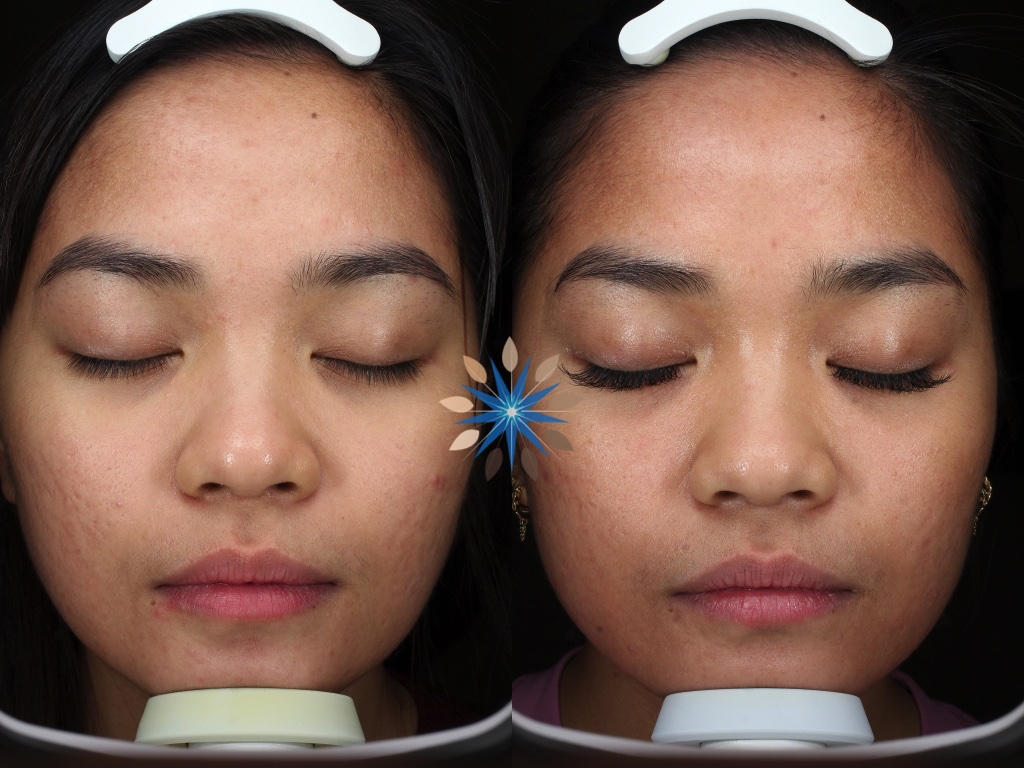 Before and After Photo of Acne Scar Removal