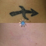 Before and After Photo of Laser Tattoo Removal of Black Tattoo