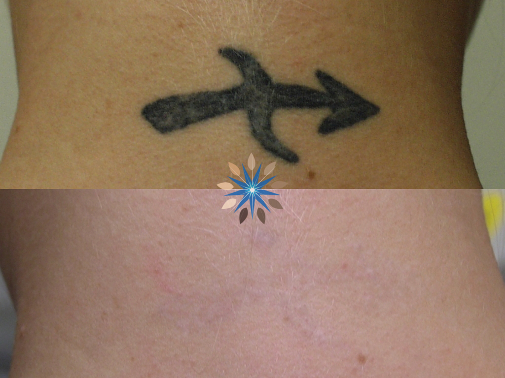 Before and After Photo of Laser Tattoo Removal of Black Tattoo
