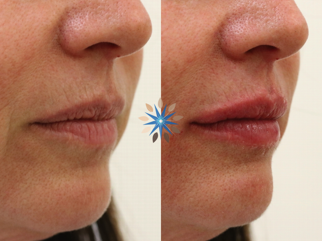 Lip Filler Before and After