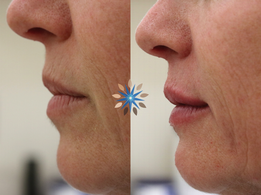 Lip Filler Before and After