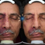 Port Wine Stain Laser Removal Before and After