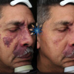 Port Wine Stain Laser Removal Before and After