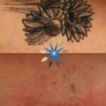 Tattoo Removal Before and After
