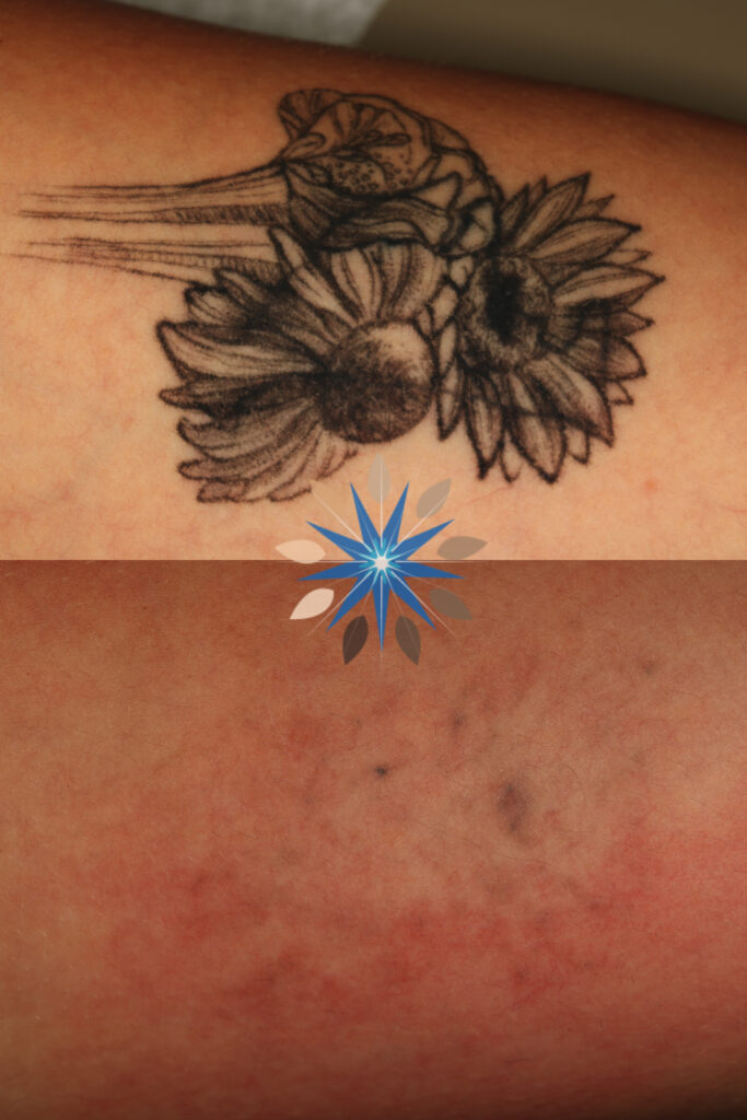 Tattoo Removal Before and After