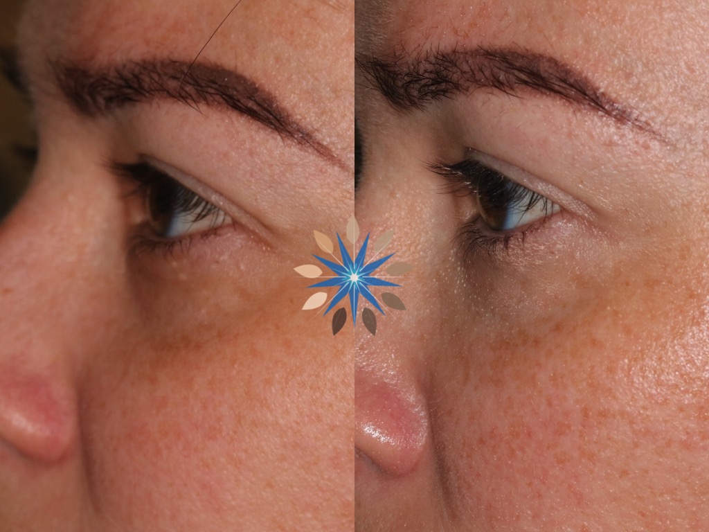Undereye Filler Before and After