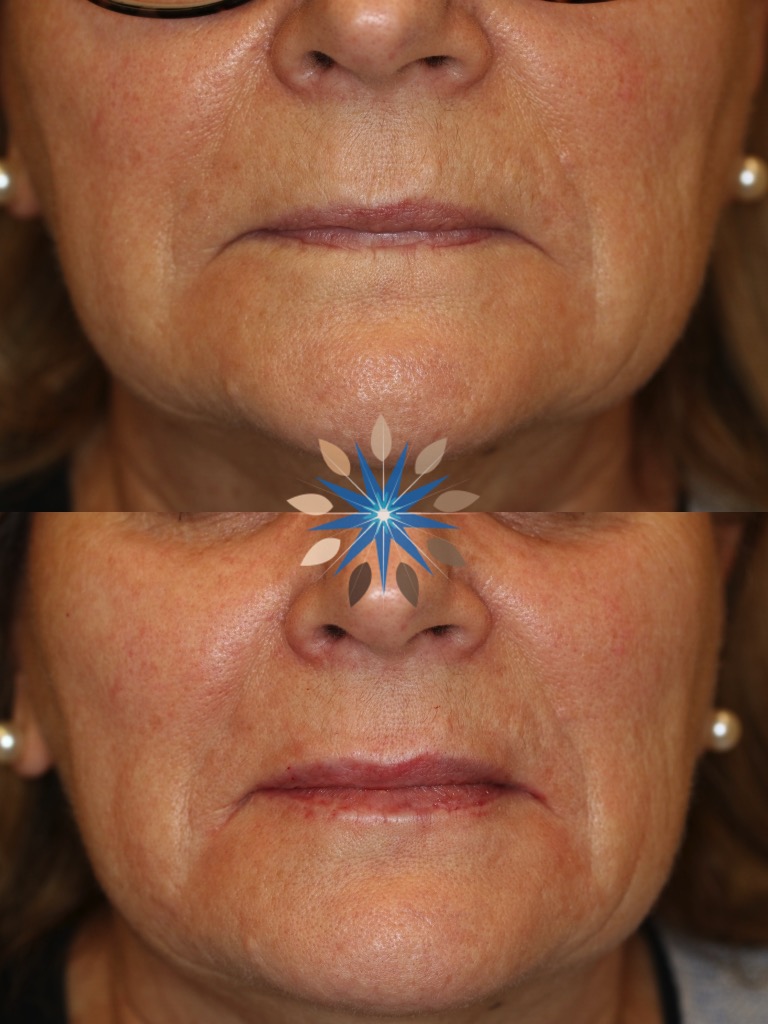 Lip Filler Before and After