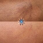 Sclerotherapy Spider Veins Before and After