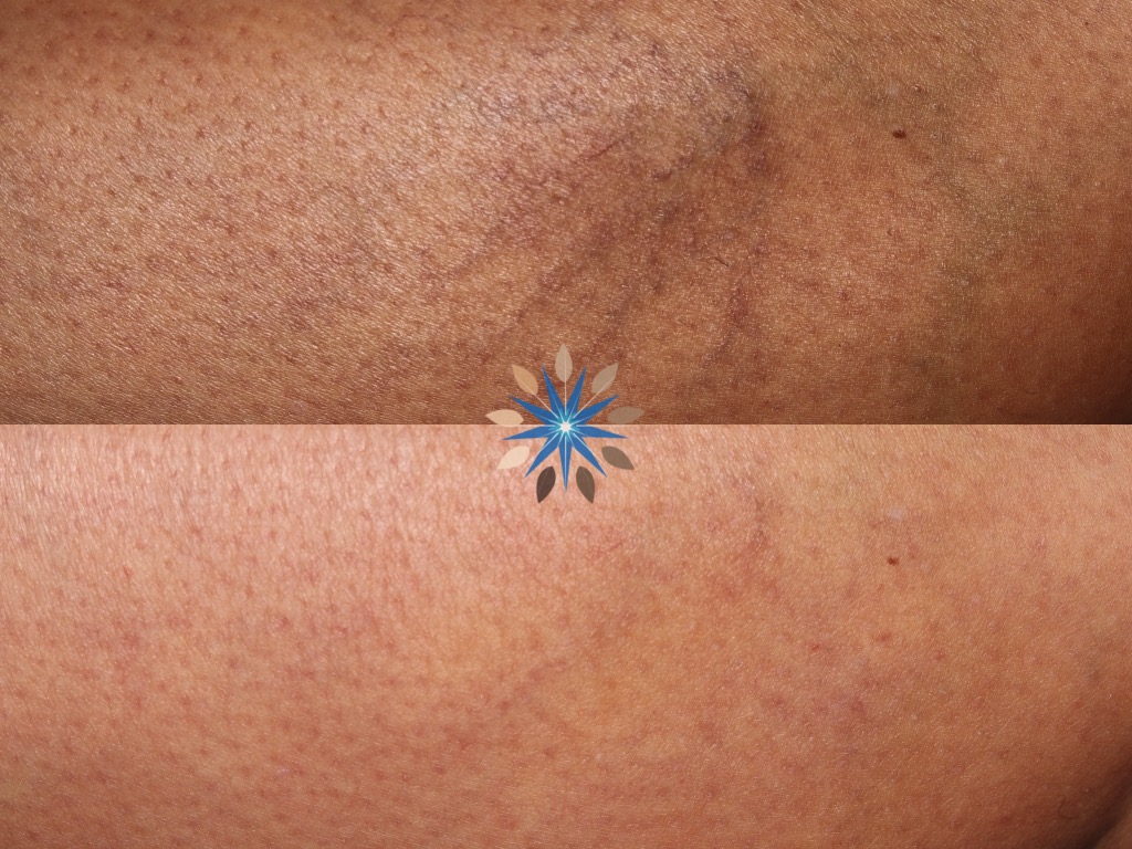Sclerotherapy Spider Veins Before and After