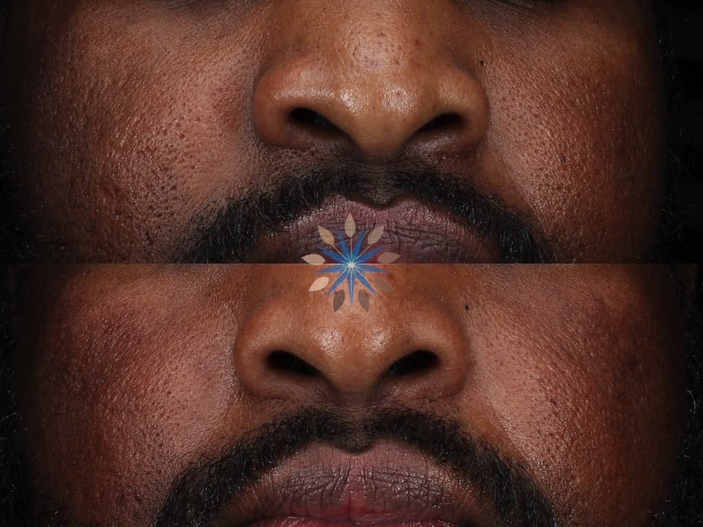 Acne Scar Treatment Before and After