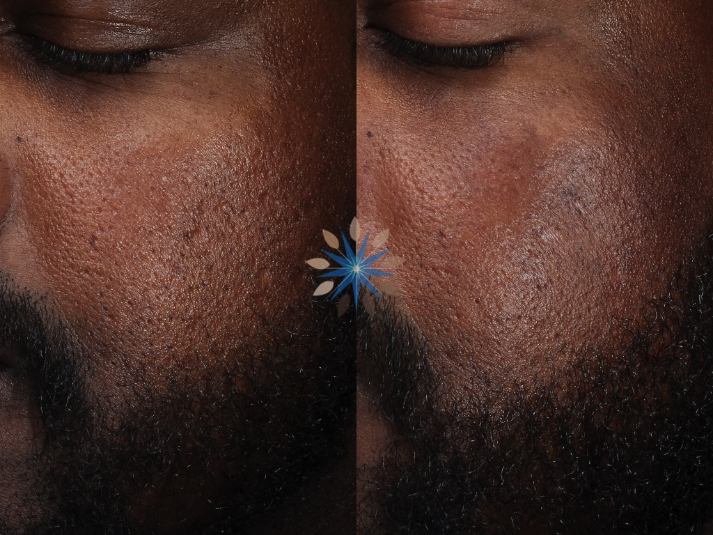 Acne Scar Treatment Before and After