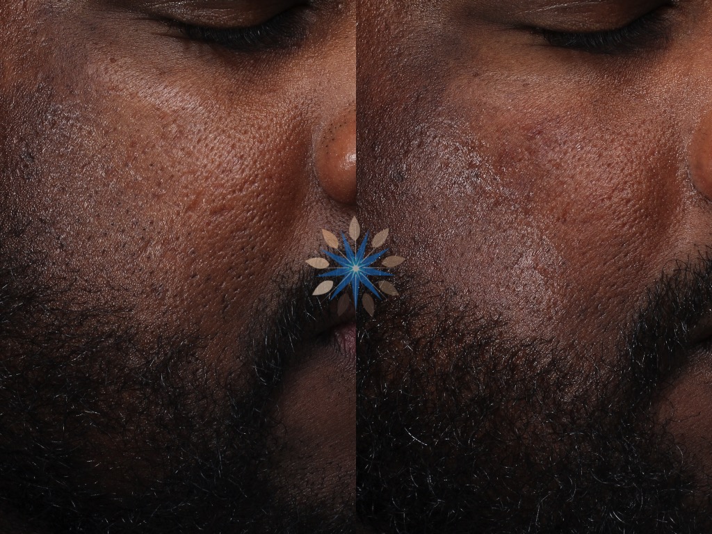 Acne Scar Treatment Before and After