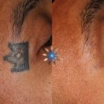 Tattoo removal before and after on darker skin tone