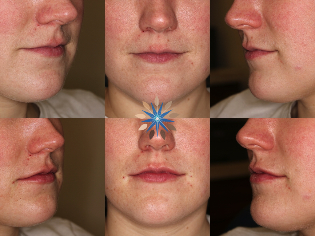 Lip Rejuvenation Before and After