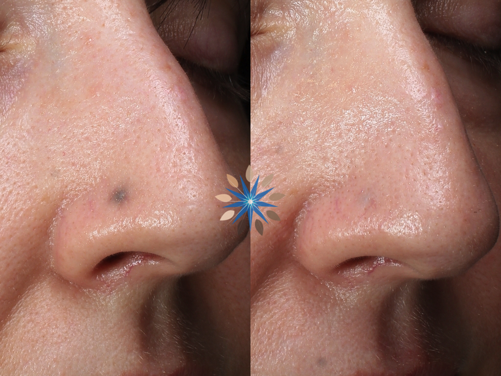 Laser Treatment of Localized Argyria Tarnish Tattoo